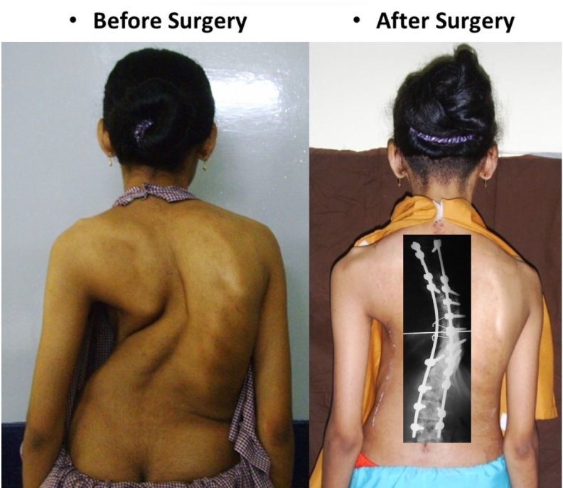 Sattvik Scoliosis Surgery