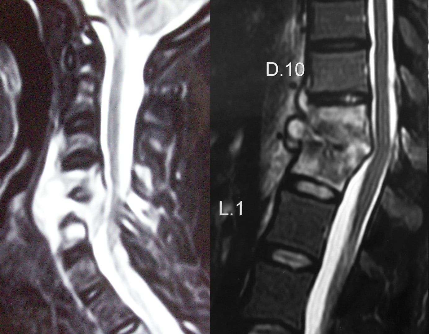Tuberculosis Of Spine