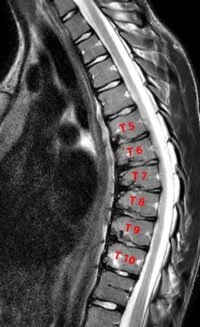 Scheuermann’s disease | Sattvik Spine | Spine Surgeon