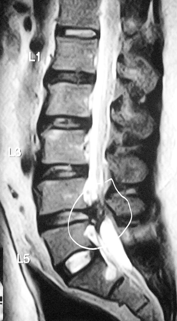 Lumbar Disk Herniation Sattvik Spine Spine Surgeon