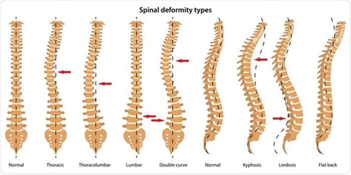 Spine Deformity - Types, Causes, and Treatments