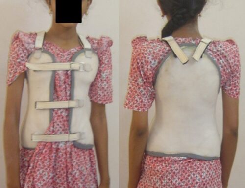HOW TO TREAT SCOLIOSIS WITHOUT SURGERY?