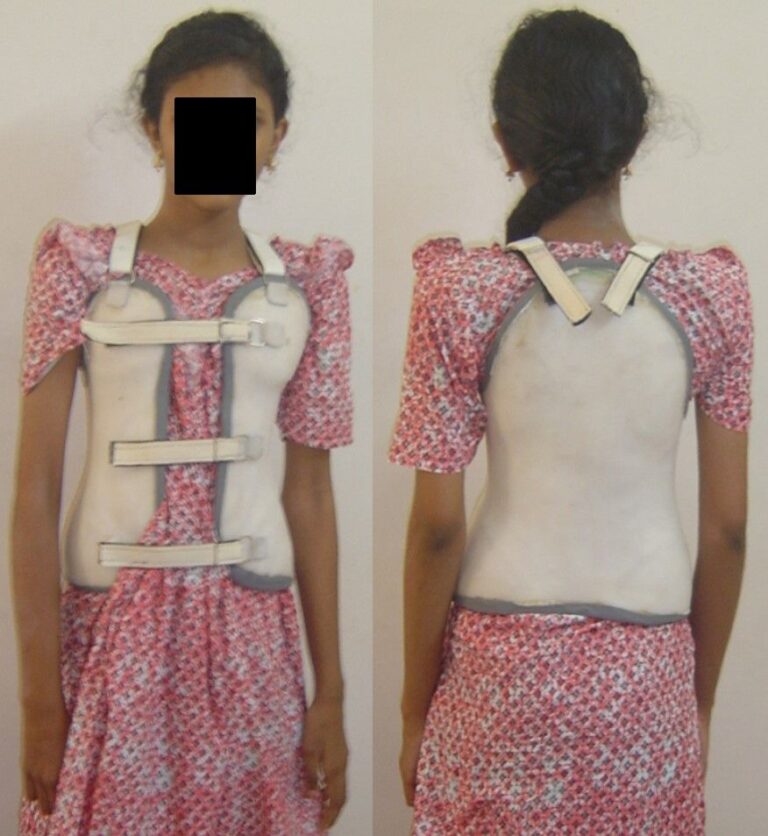 TREAT SCOLIOSIS WITHOUT SURGERY