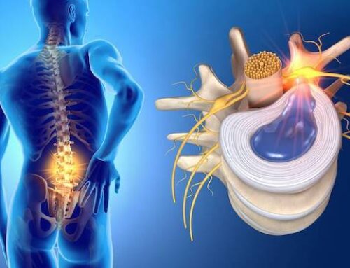 Pinched Nerve in the Back – Symptoms to Watch Out For