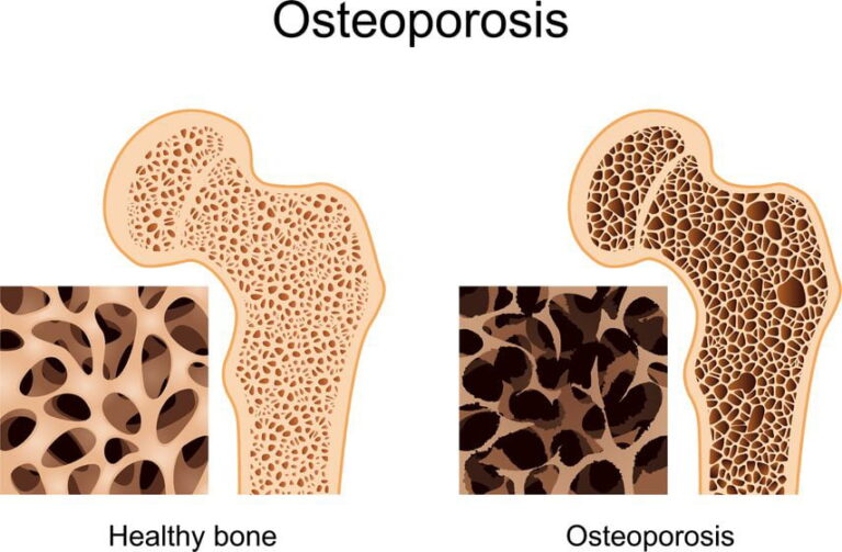 Understanding Osteoporosis Symptoms Causes and Treatment