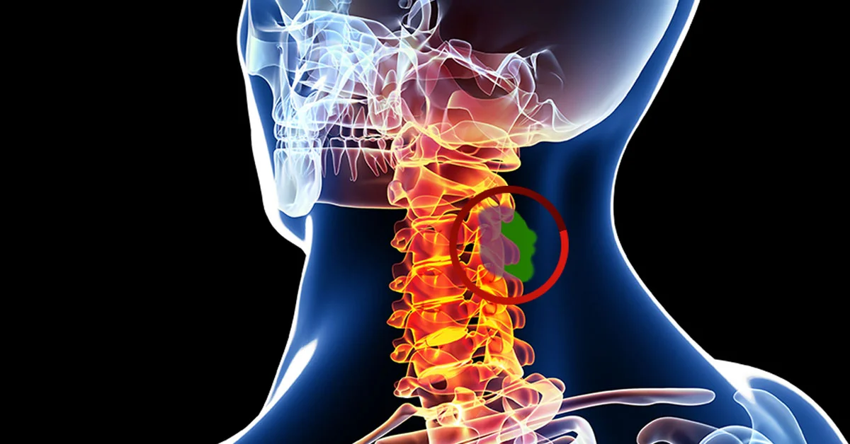 Spinal Tumors:, Symptoms, Causes, and Treatments