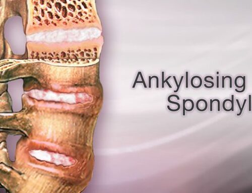 Ankylosing Spondylitis: Causes, Symptoms, and Treatment Options