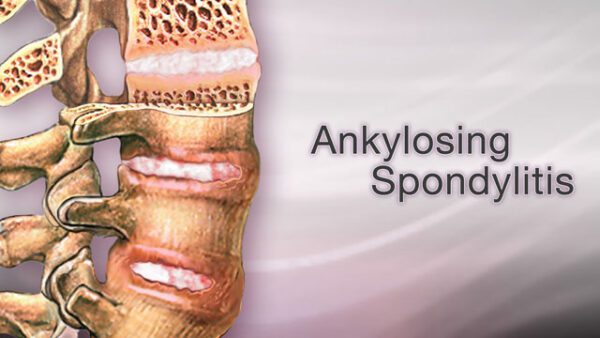 Ankylosing Spondylitis: Causes, Symptoms, and Treatment Options ...