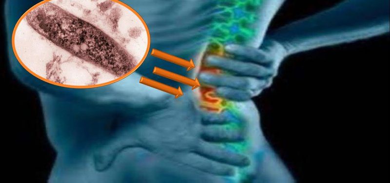 Spinal Tuberculosis Symptoms: A Comprehensive Guide to Understanding Pott's Disease