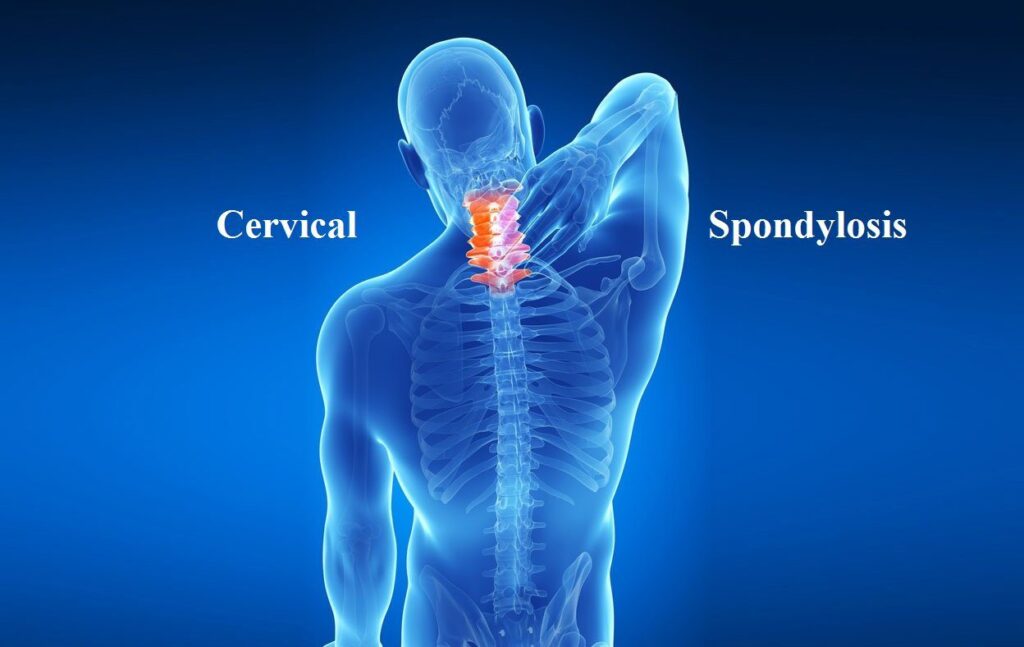 Understanding the Causes of Cervical Spondylosis: A Comprehensive Guide
