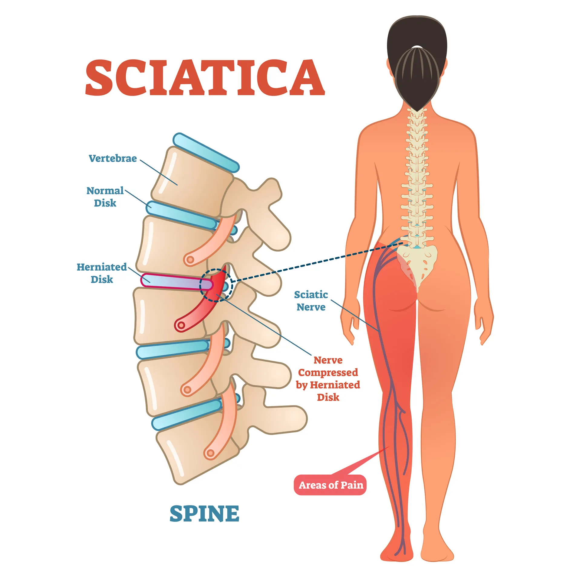 Sciatica-nerve-a099d0f