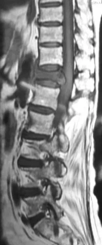 05. spinal tumour 200x482.jpg