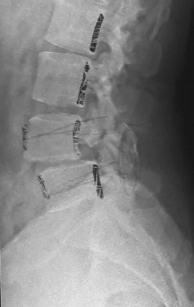 07. spondylolisthesis 400x633.jpg