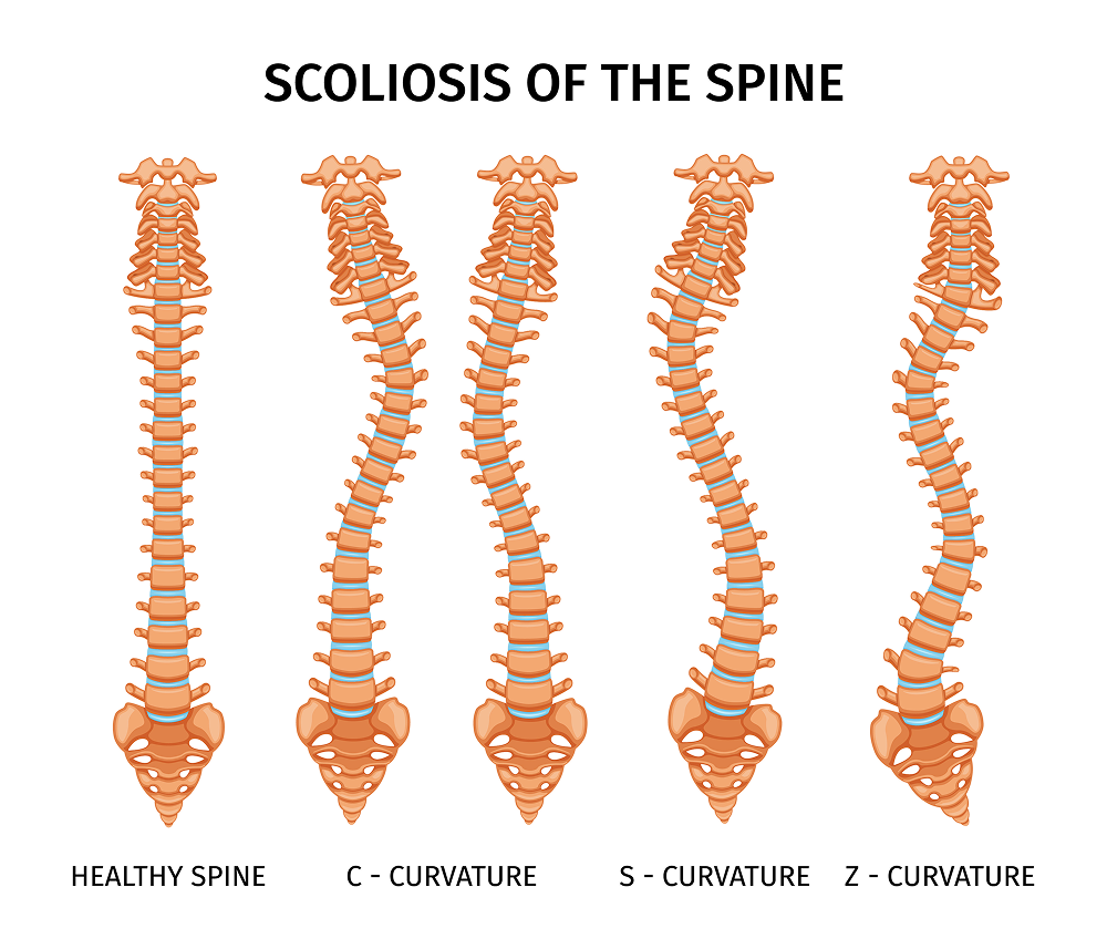 64993443_2308.i504.011.S.m005.c13.types scoliosis spine infographics 1