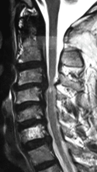 cervical spondylosis 200x355