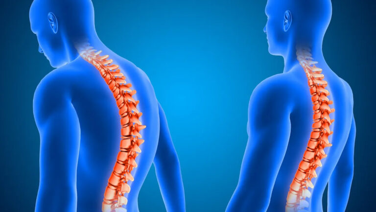Serious Back Pain